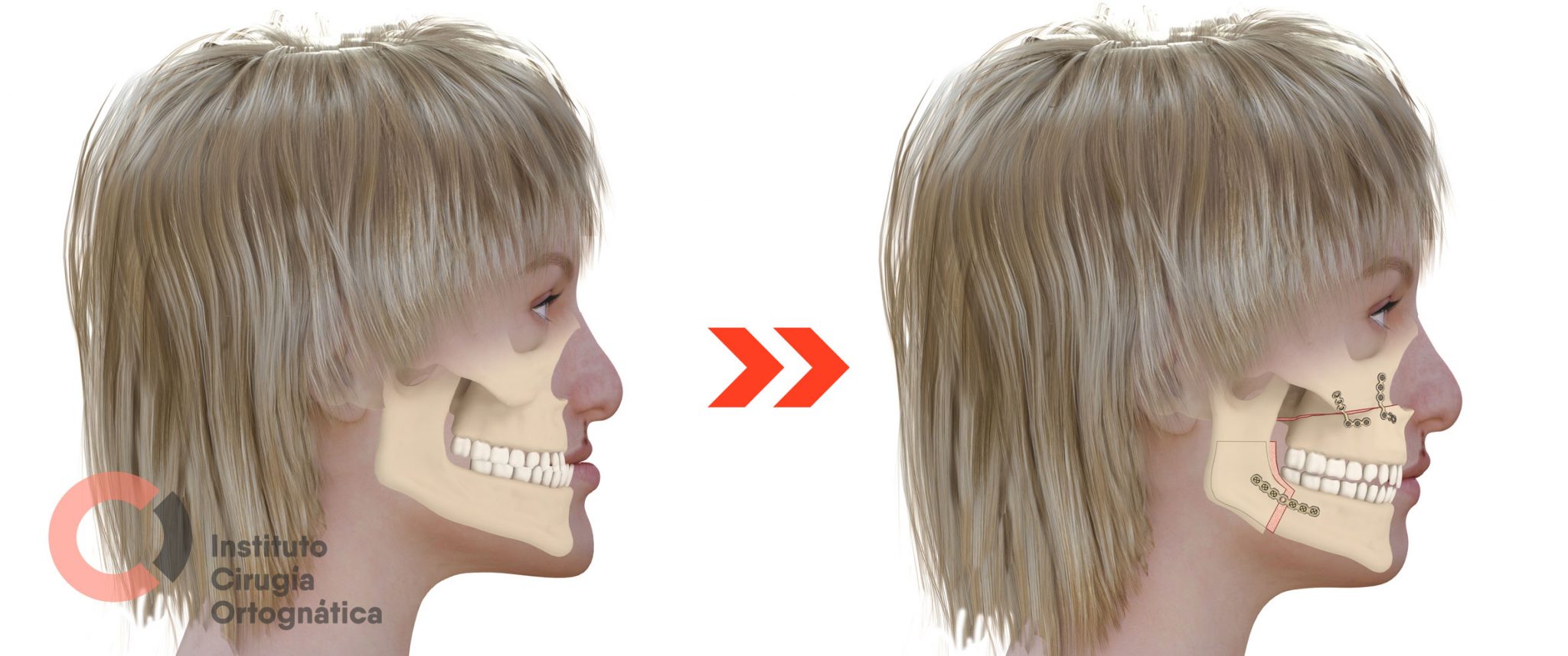 Labio Leporino O Fisurado: Qué Es Y Tratamiento - Instituto Cirugía ...